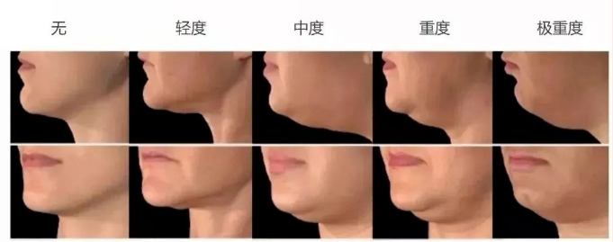 下颌缘提升有什么效果