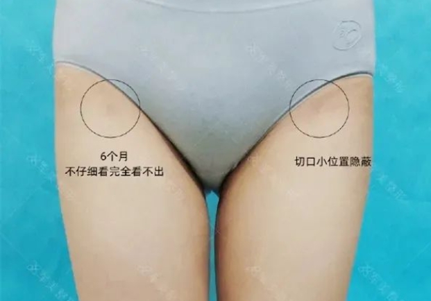 大腿吸脂术后护理注意事项