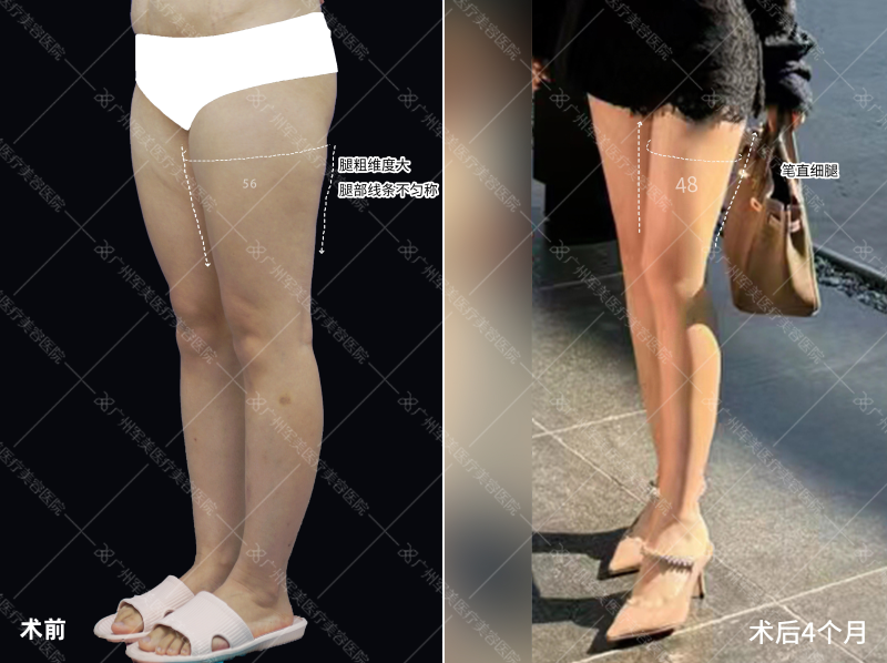 大腿吸脂效果图