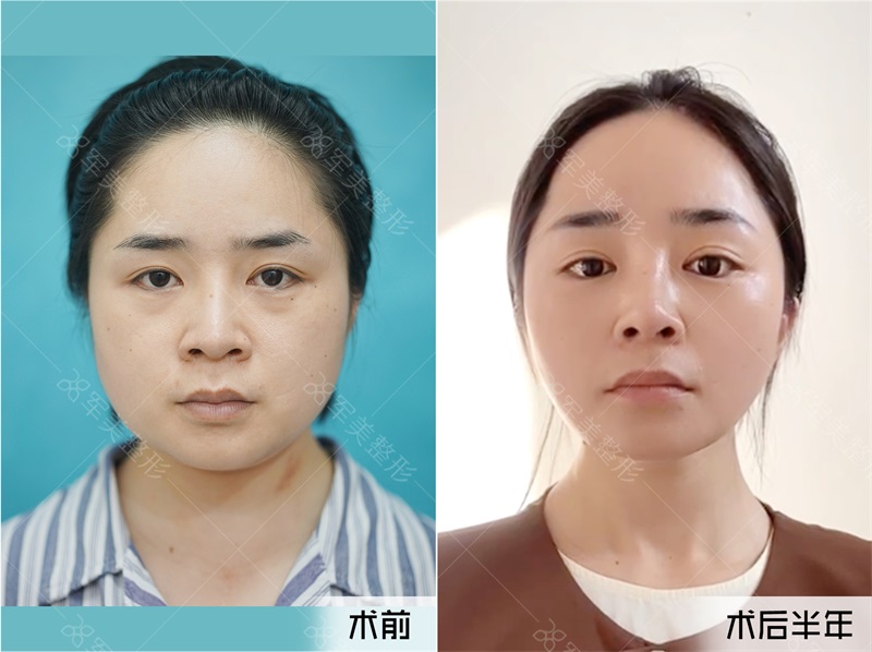 脸垮下垂改善案例