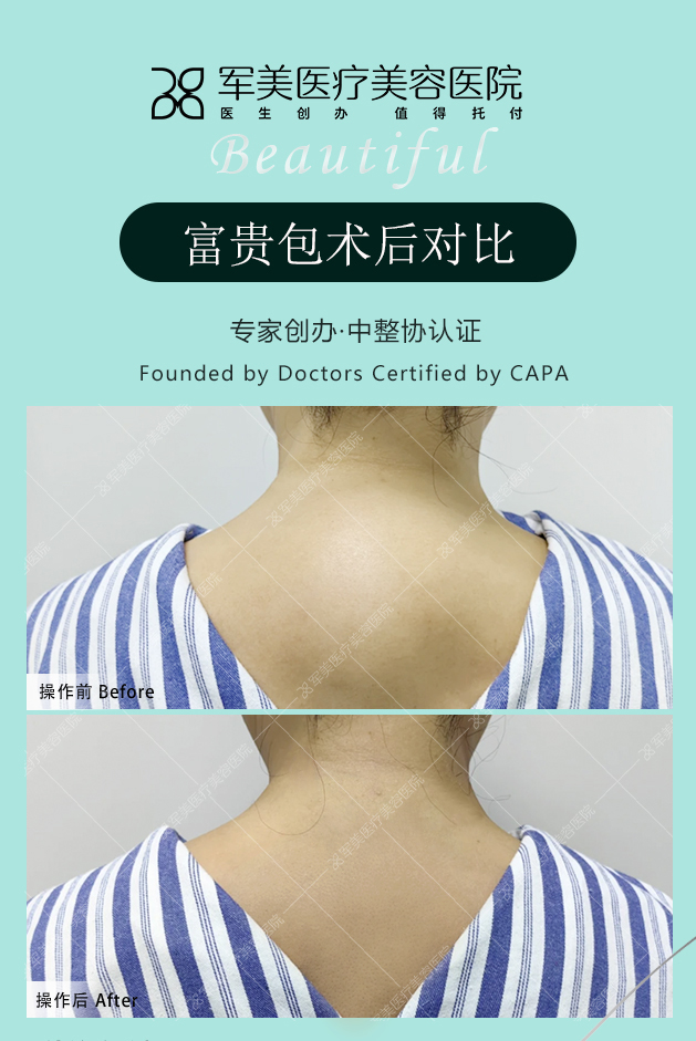 富贵包吸脂案例