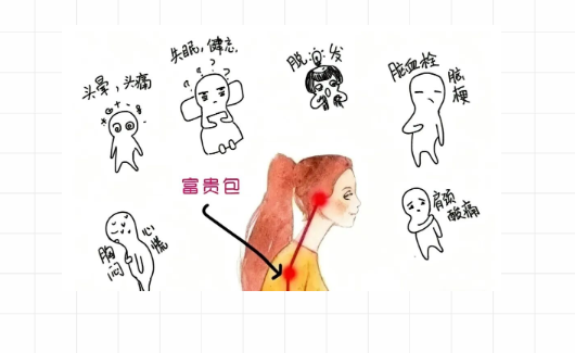 怎么改善富贵包