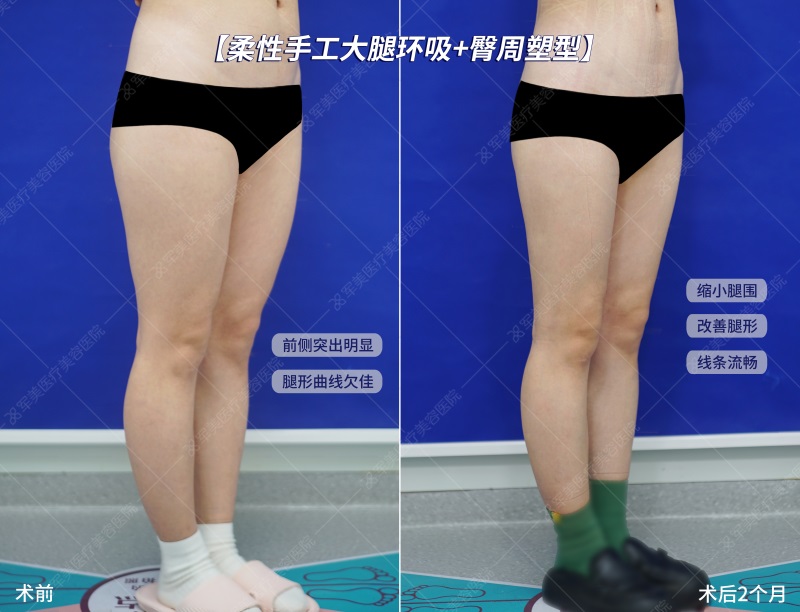 妈妈臀抽脂前后对比