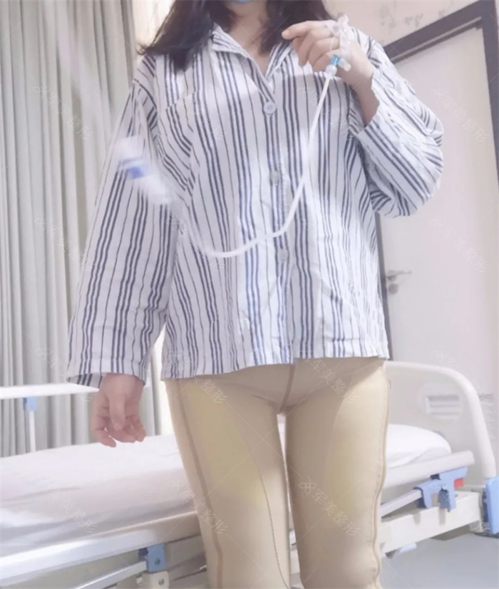 大腿吸脂前后效果图片