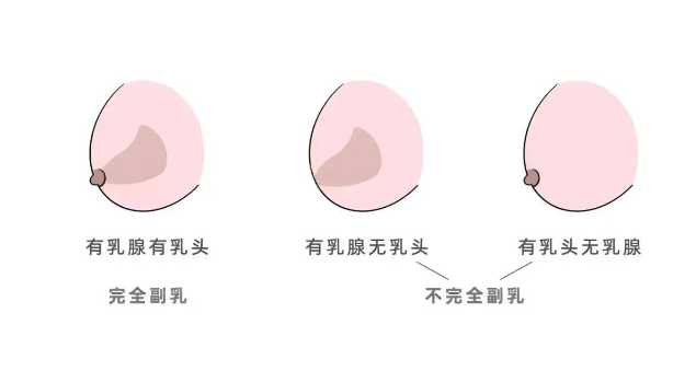 副乳怎样才可以消除