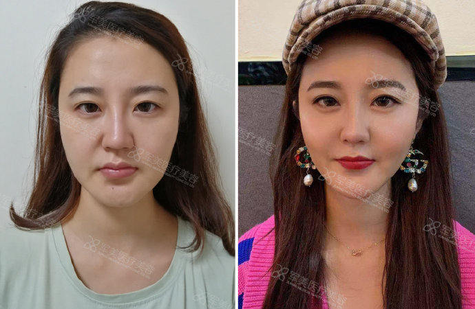 脸大做面吸案例