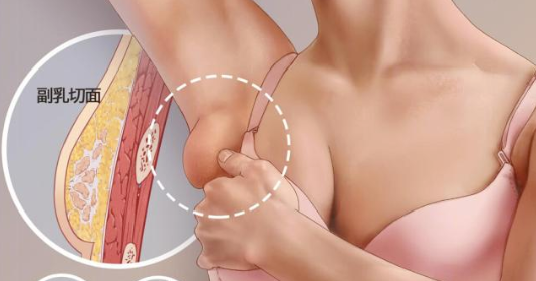 副乳是怎么来的
