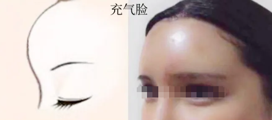 自体脂肪填充面部会馒化吗