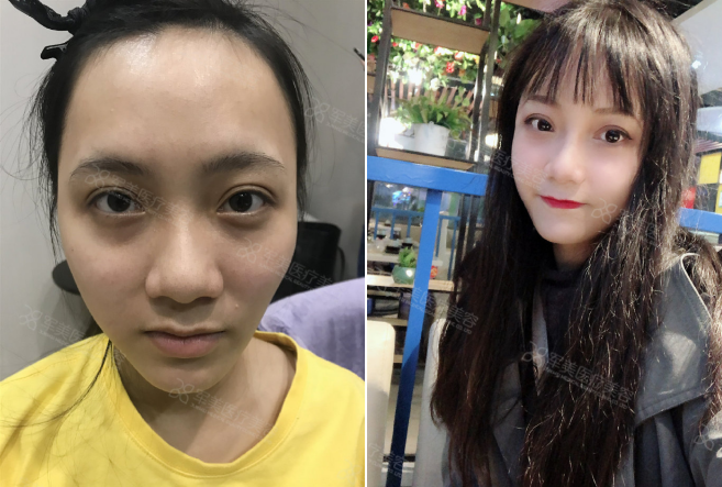 自体脂肪填充面部多久能存活