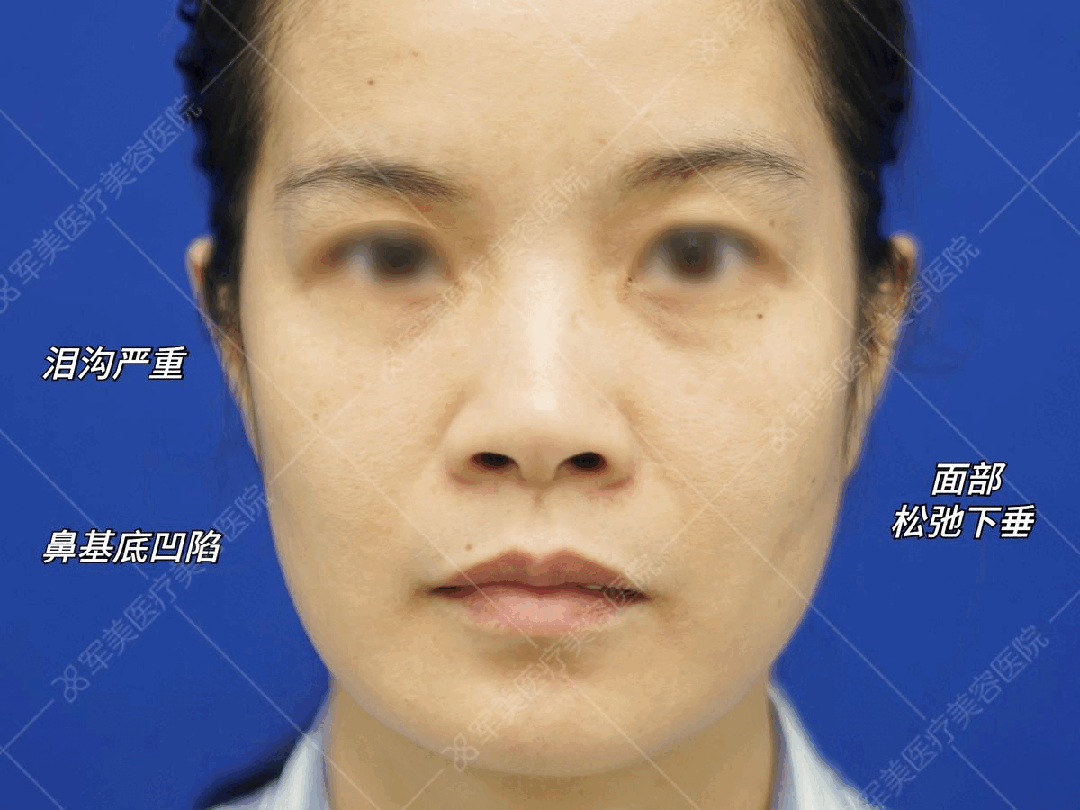 面部抗衰提升案例