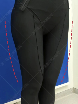 吸脂后一定要穿塑身衣