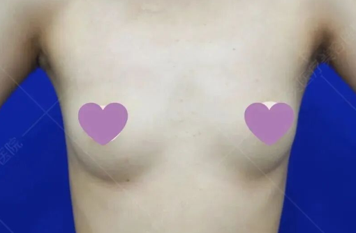 自体脂肪隆胸哪家医院比较好