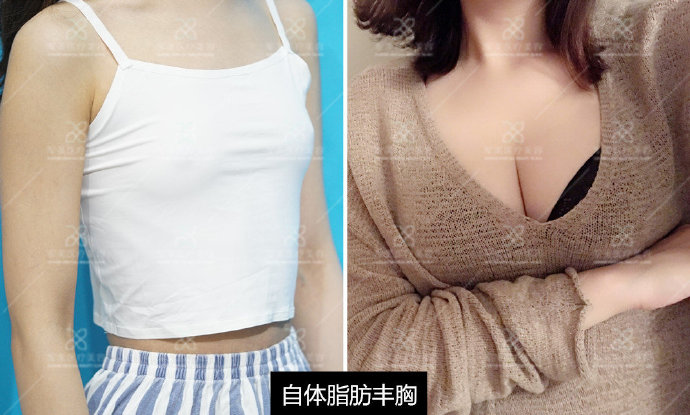 广州军美吴国勇自体脂肪填胸