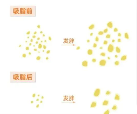 吸脂后注意事项有哪些