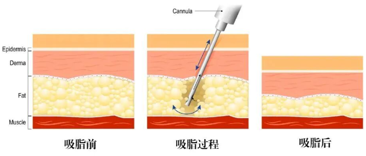广州吸脂哪家好