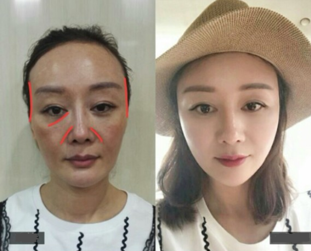 自体脂肪填充面部案例