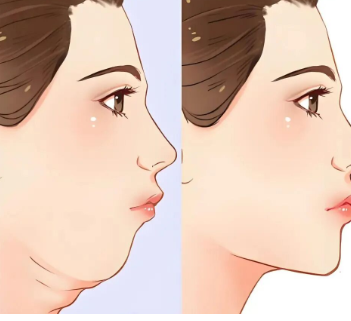 双下巴怎么瘦掉