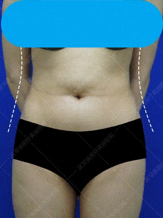 广州吴国勇吸脂案例