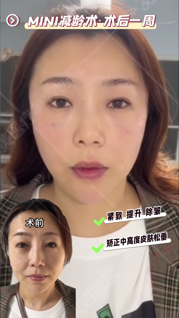 面部松弛下垂怎么解决