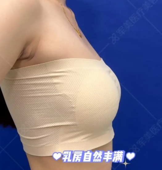 王世虎脂肪隆胸案例