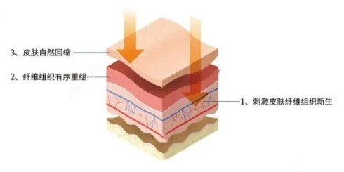 吸脂后皮肤会变松弛吗