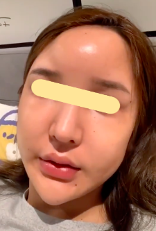 馒化脸是怎么形成的