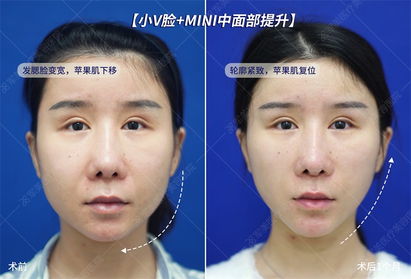 面部提升最好的方法