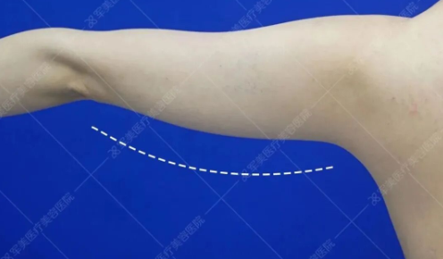 手臂粗大怎么办才能变细