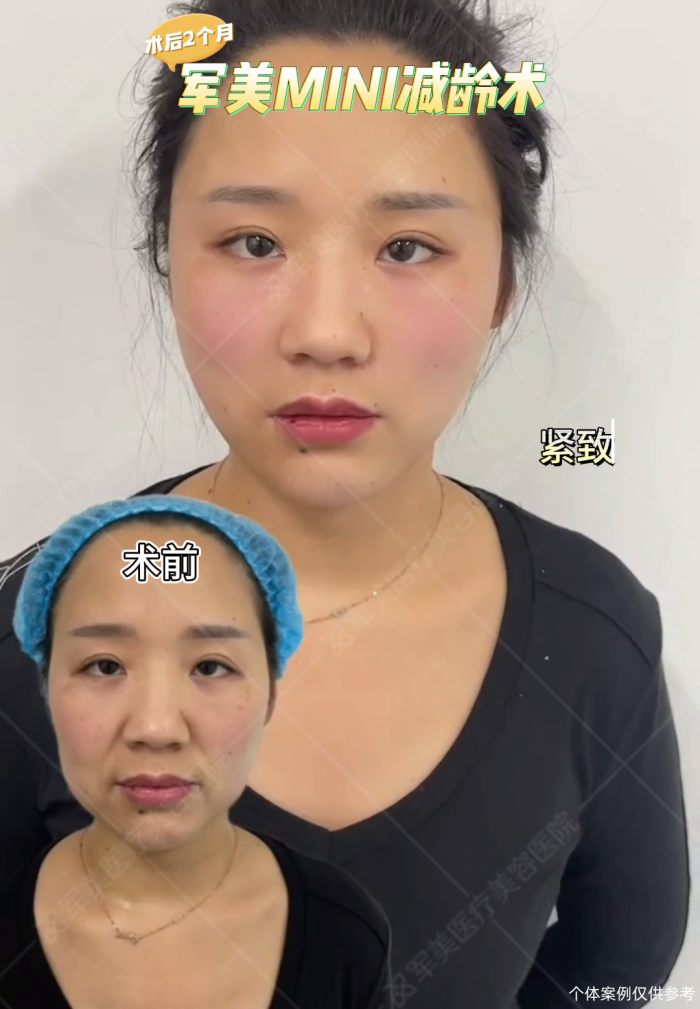 面部筋膜提升抗衰案例