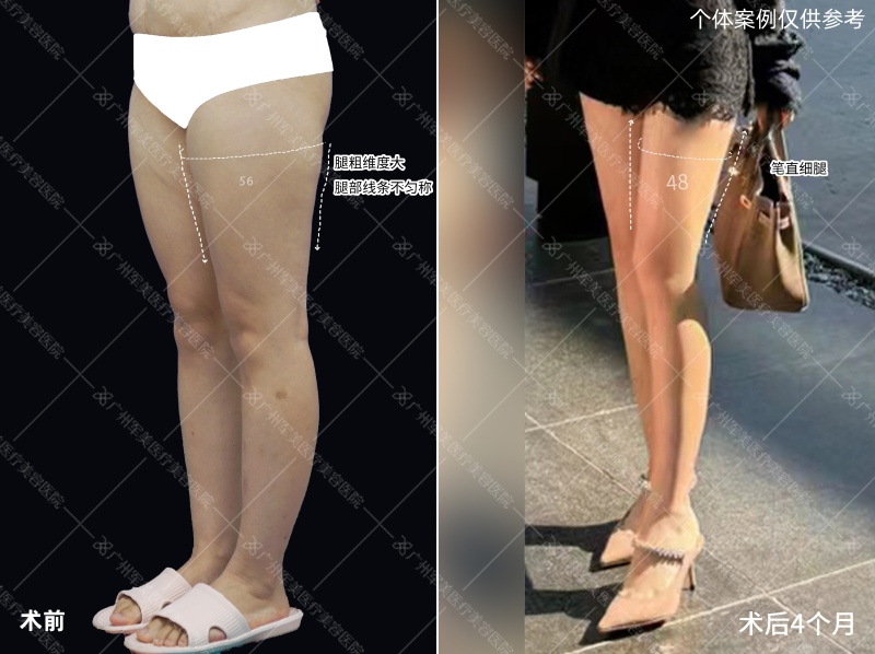 王世虎吸脂案例