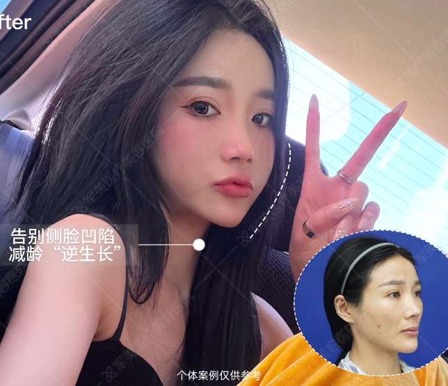 自体脂肪填充面部效果图