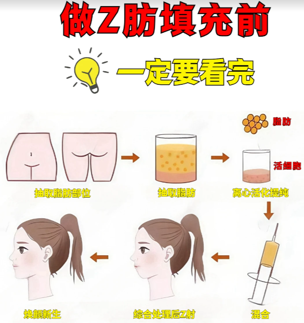 自体脂肪填充原理图