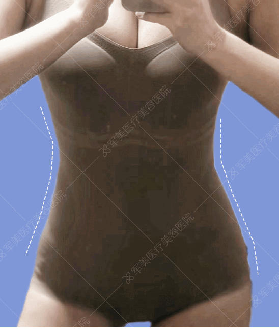 腰腹环吸和脂肪丰臀案例