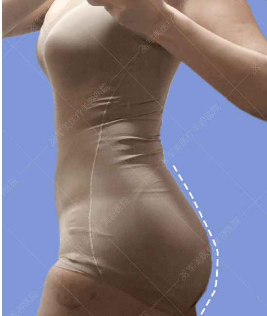 腰腹环吸和脂肪丰臀案例