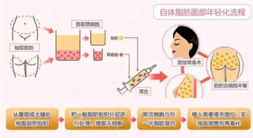 自体脂肪填充原理