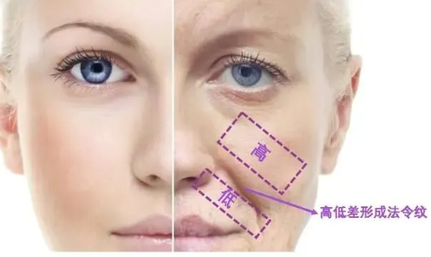 法令纹深是什么原因导致的