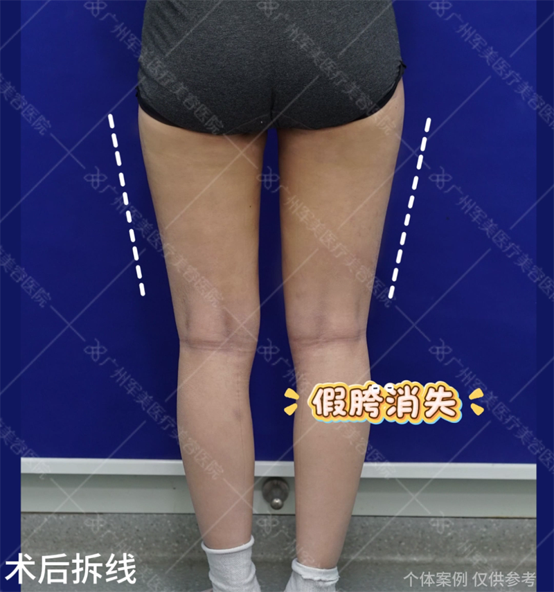 假胯宽吸脂改善案例