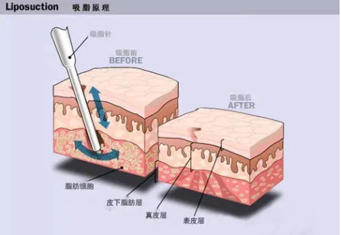 吸脂原理