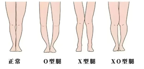 腿型矫正