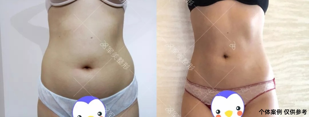 王世虎腰腹吸脂真实案例