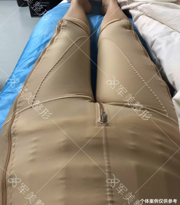 王世虎吸脂真实案例