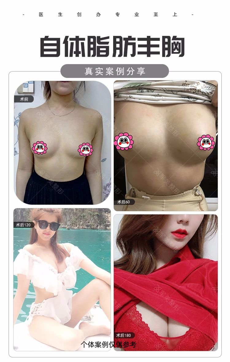 王世虎自体脂肪丰胸案例