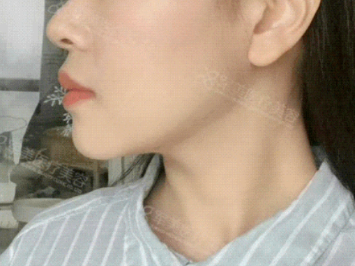 面部吸脂术后带头套图
