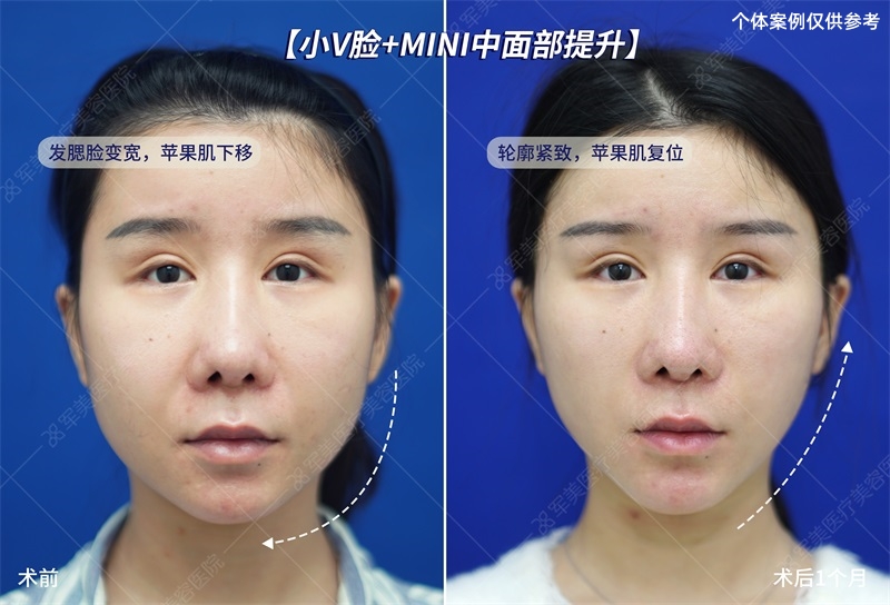 面部抗衰老提升案例