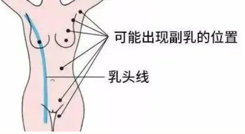 副乳是怎么形成的
