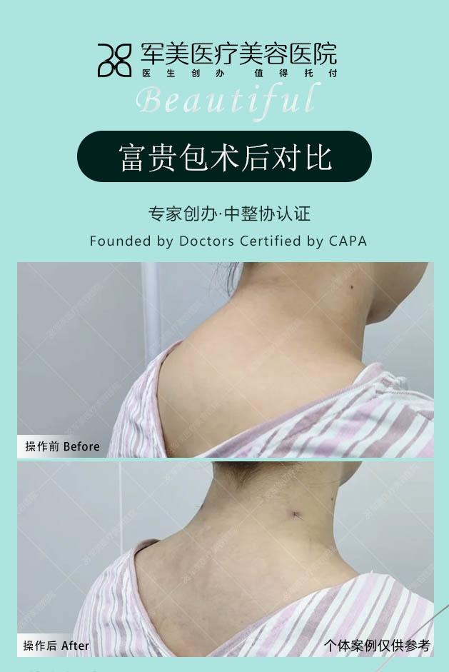 富贵包吸脂案例